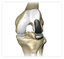 Unicondylar knee