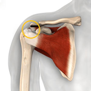 shoulder-arthroscopy-rotator-cuff-tear-2