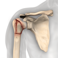 shoulder-pain-shoulder-fracture-2